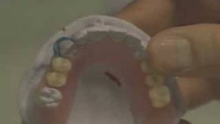 DurAcetal Clasps to a nylon partial, waxing setup.