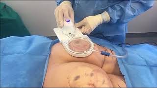 CellFina | Cellulite Treatment | Sarah Yovino MD | Beverly Hills | Ideal Face & Body