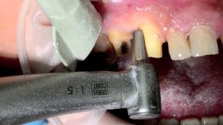 Cas clinique Bridge Céramique Cerec direct et PAG, Dr Jacques Raynal
