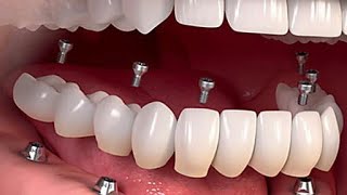 The Cost Of 2019 Dental Implants Might Surprise You