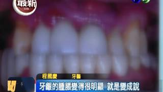 連嗑3天麻辣鍋 女子急性牙齦炎