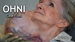 PAROTIDECTOMY for GIANT FACIAL TUMOR