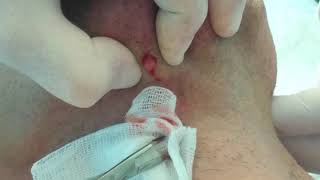 Pimple, Boil, Zit on Face. Выдавливание прыща на лице.