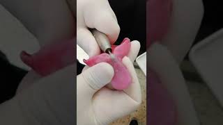 Visit 2: checking the tray inside the patient's mouth