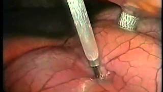 Laparoscopic pancreatic cystgastrostomy 1- UCSF Lawrence Way, MD
