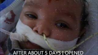AMARIYAH GRACE SURVIVOR OF SHAKEN BABY SYNDROME
