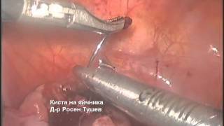 Ovarian cyst / Киста на яйчника - Rossen Tushev M. D