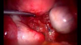 Endometriosis