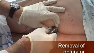 Anoscopy