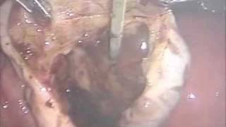 チョコレート嚢腫摘出術