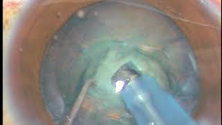 Watch keenly these steps of Phacoemulsification - PM, 20/3/2018
