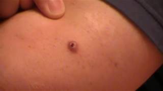 Removing 14 year old Glass from my Elbow