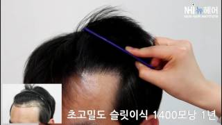 초고밀도 슬릿 모발이식 1400모낭 Dense packing hair transplantat (slit method) 1400 grafts after 1year