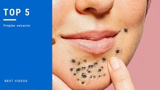 TOP 5 pimples Выдавливание прыщей