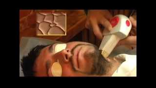 Epilation Man Russia