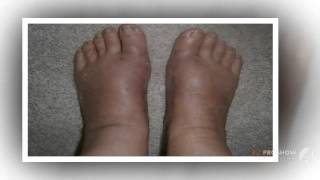 выпрямитель большого пальца ноги

  - Valgus pro купить