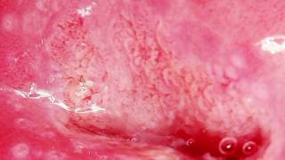DIGITAL COLPOSCOPY HD PRESENTATION PART III
