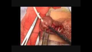HYPOSPAIDIAS, TIP REPAIR, SNODEGRASS
