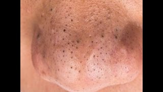 Выдавливание черных точек, угрей на носу/Nose Blackheads Squeezing