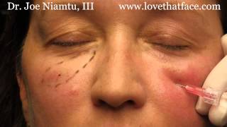 5 minute cheeks by Dr. Joe Niamtu, III