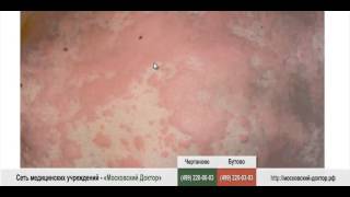 Аллергия – сыпь по всему телу