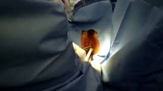 surgitoolsmis cervigrip uterine manipulation   tubal dye injection 721