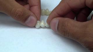 E.max and Zirconia FDPs (Bridge)