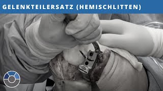 Kniearthrose - Gelenkteilersatz (Hemischlitten)