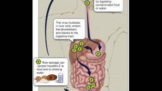 HEPATITIS E , HEALTH EDUCATION , INFECTION CONTROL (ICSP) , URDU / HINDI