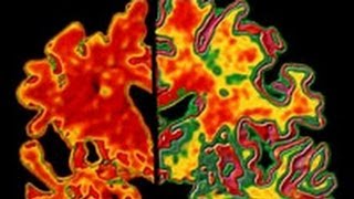 Alzheimer's Test Can Detect Disease Decades in Advance