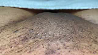 INGROWN HAIR REMOVAL