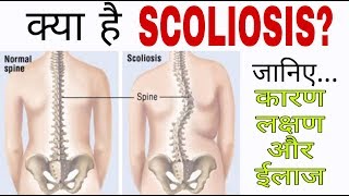 Scoliosis in hindi | Scoliosis kya hai? | Scoliosis exercises | Dr. Pratibha Singh(PT)