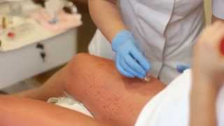 Mezoterapia mikroigłowa (2 min. 30 sek.)