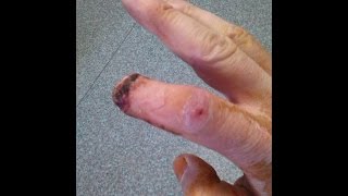 Fingertip cut off by motorcycle sprocket. Healing process *graphic*