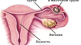 Արտարգանդային հղիություն