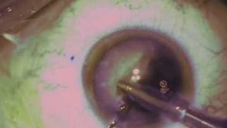 Complex Cataract Surgery