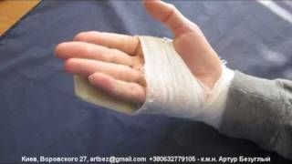 Two stage flexor tendons grafting / Двухэтапная пластика сухожилия