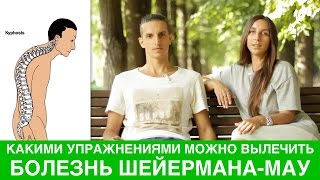 Болезнь Шейермана - Мау и упражнения для осанки