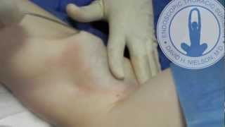 SDLA - How to Treat Armpit Sweating for Hyperhidrosis?