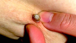 Huge blackhead on my thigh! Part 2
