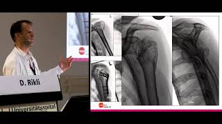 medArt2019: Freitag 08 D Rikli Proximale Humerus FX des Aelteren