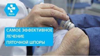 ? Как лечить пяточную шпору методом ударно волновой терапии. Пяточная шпора как лечить. ЭДЕМ. 12+