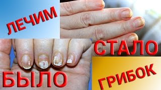 грибок ногтей на руках