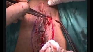Prof. Dr. Ateş Karateke - Skinning Vulvektomi
