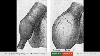 Обрезание при фимозе