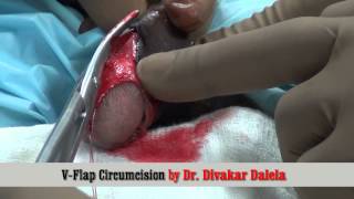 V Flap Circumcision
