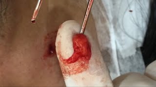 微創額頭脂肪瘤切除 莊禮謙醫師，remove Lipoma, minimal incision, hide the incision inwrinkles, Dr George