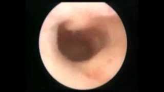 Office hysteroscopy Uterus didelphys TOUR