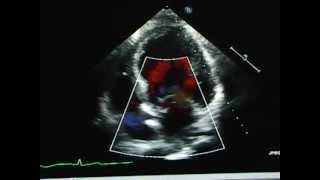 Isolated Mitral leaflet Cleft