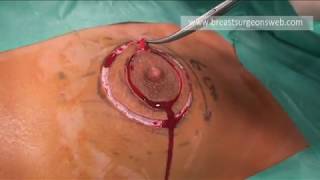 Round-Block for Giant fibroadenoma of the breast